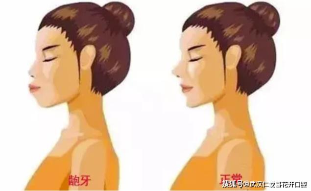 武漢仁愛(ài)口腔怎么樣?【真實(shí)案例】牙齒矯正,拯救你的臉!