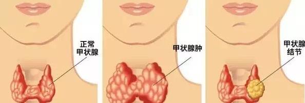 甲狀腺結(jié)多大算正常范圍之內(nèi)?武漢民生耳鼻喉醫(yī)院24h在線免費(fèi)咨詢預(yù)約