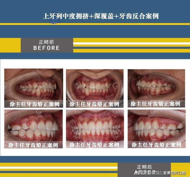 武漢仁愛(ài)口腔怎么樣?【真實(shí)案例】牙齒矯正,拯救你的臉!
