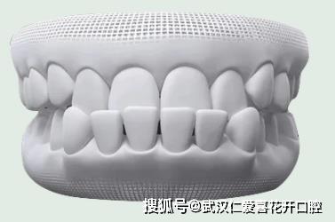 武漢仁愛(ài)口腔怎么樣?【真實(shí)案例】牙齒矯正,拯救你的臉!
