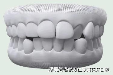 武漢仁愛(ài)口腔怎么樣?【真實(shí)案例】牙齒矯正,拯救你的臉!