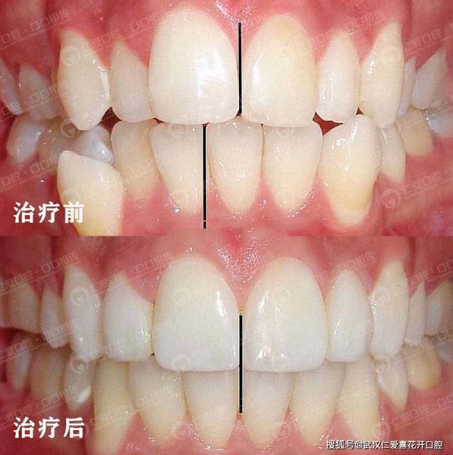武漢仁愛(ài)口腔怎么樣?【真實(shí)案例】牙齒矯正,拯救你的臉!