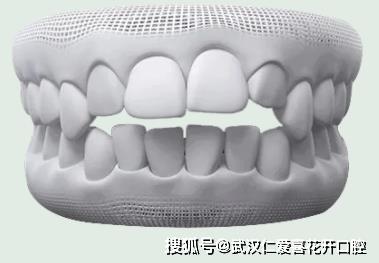 武漢仁愛(ài)口腔怎么樣?【真實(shí)案例】牙齒矯正,拯救你的臉!