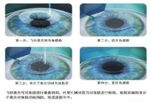 選擇全飛秒還是半飛秒?鄭州尖峰眼科:適合自己的才是最好的!