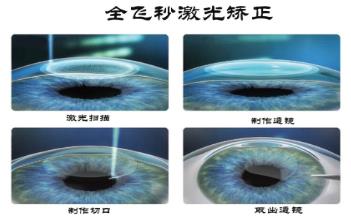 選擇全飛秒還是半飛秒?鄭州尖峰眼科:適合自己的才是最好的!