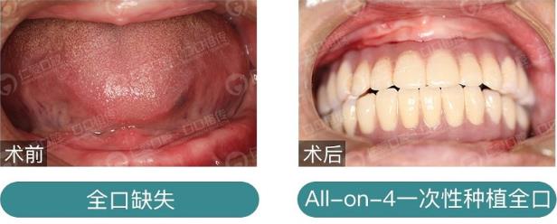 武漢仁愛(ài)口腔種植技術(shù)怎么樣?【種植牙案例】能吃能喝的美好生活,才有盼頭!