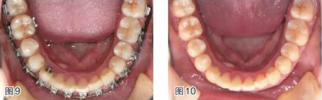 武漢仁愛口腔-磨牙近中移動的正畸臨床案例-磨牙拔除間隙應(yīng)該如何解決?