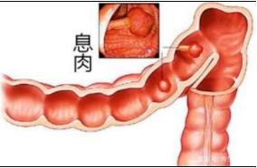 合川宏仁醫(yī)院結(jié)腸息肉腺瘤不用怕,醫(yī)生支招“繞開”癌