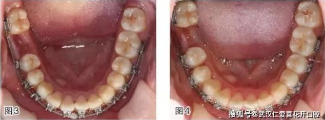 武漢仁愛口腔-磨牙近中移動的正畸臨床案例-磨牙拔除間隙應(yīng)該如何解決?