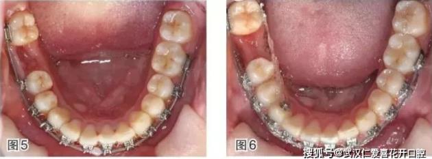 武漢仁愛口腔-磨牙近中移動的正畸臨床案例-磨牙拔除間隙應(yīng)該如何解決?