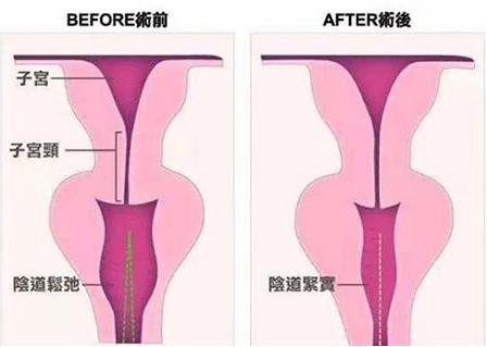 重慶軍科私密整形醫(yī)院,發(fā)生陰道松弛怎么辦?