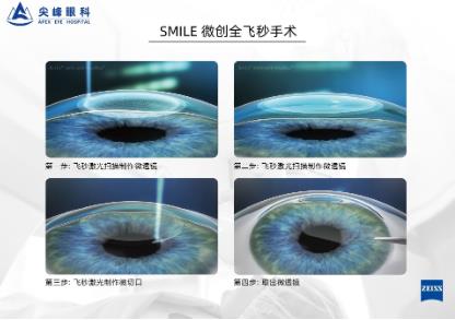 鄭州尖峰眼科:近視參軍適合做哪種近視手術(shù)?