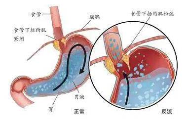 呼市東大肛腸醫(yī)院 反胃、吐酸水?胃酸過多是一種怎樣的體驗?