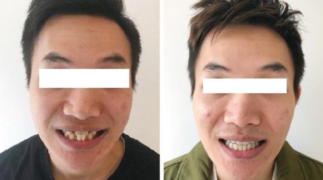 【矯正案例】兩則 美麗蛻變 從選擇武漢仁愛口腔醫(yī)院開始!