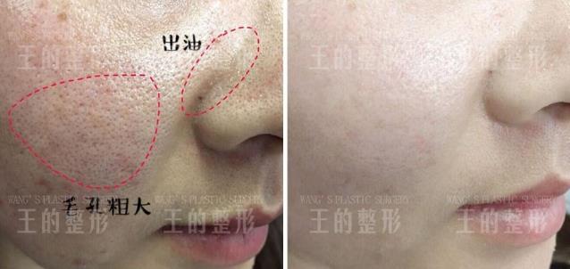 3支水光針中只有1支是正品?王的整形王鳳波教你看懂水光