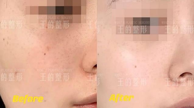 3支水光針中只有1支是正品?王的整形王鳳波教你看懂水光