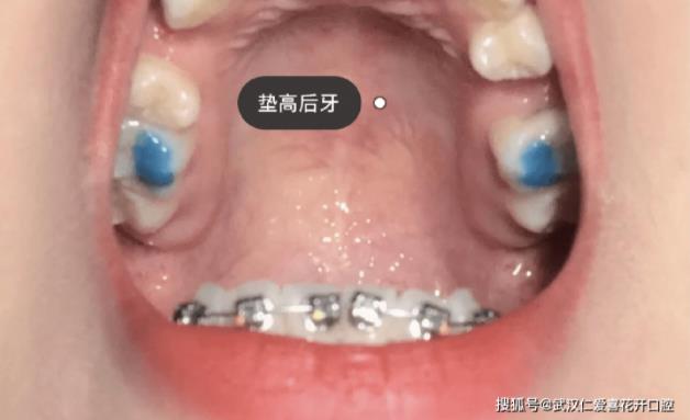 網(wǎng)友:年齡大了還能矯正嗎?武漢仁愛口腔醫(yī)師告訴你:整牙任何時候都不晚!