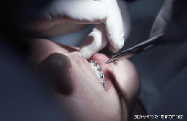 武漢仁愛口腔醫(yī)師告訴你:牙齒矯正復(fù)診少不了