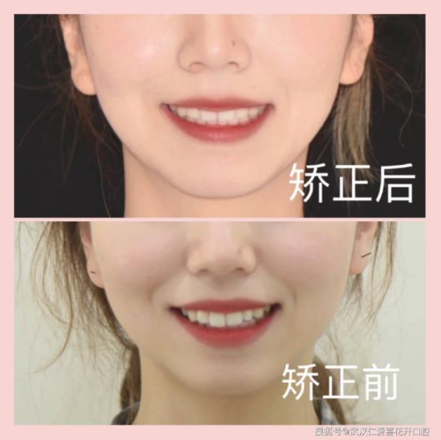 網(wǎng)友:年齡大了還能矯正嗎?武漢仁愛口腔醫(yī)師告訴你:整牙任何時候都不晚!