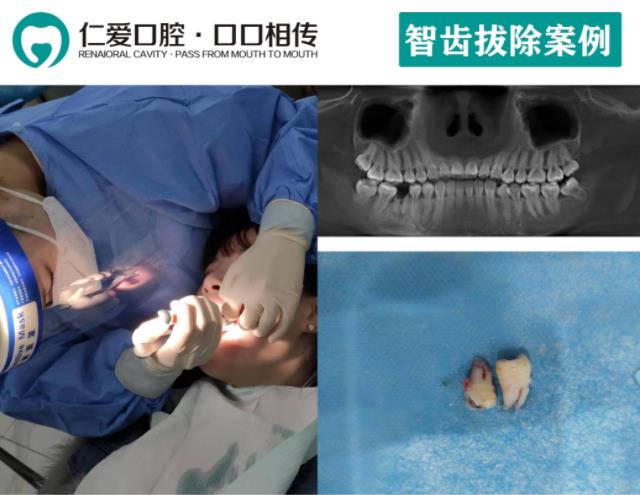 武漢哪家醫(yī)院拔牙技術(shù)好?武漢仁愛口腔微創(chuàng)拔牙,零創(chuàng)傷!