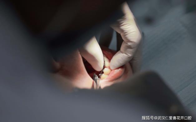 武漢仁愛口腔醫(yī)師告訴你:牙齒矯正復(fù)診少不了