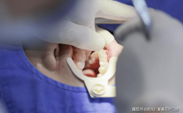 武漢仁愛口腔醫(yī)師告訴你:牙齒矯正復(fù)診少不了
