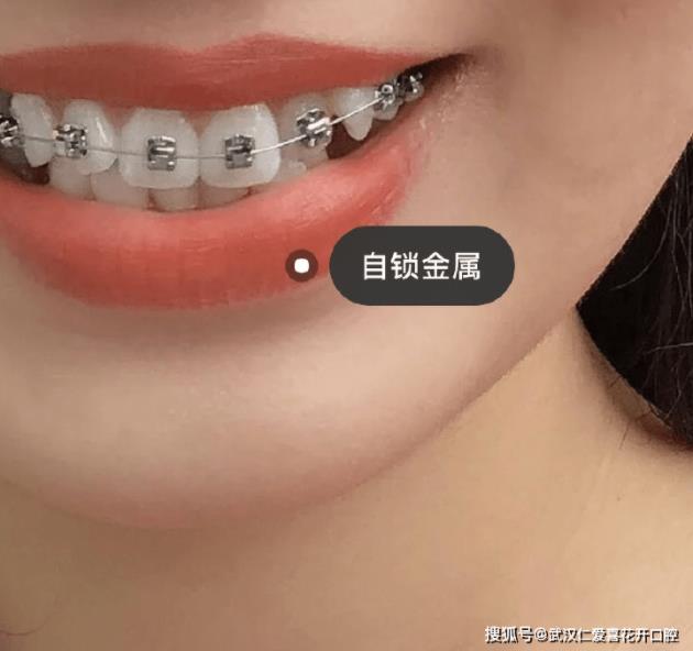 網(wǎng)友:年齡大了還能矯正嗎?武漢仁愛口腔醫(yī)師告訴你:整牙任何時候都不晚!