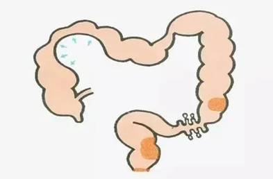 廣州東大肛腸醫(yī)院黑不黑此路不通。堵著堵著就越來越腸子卡了一大團(tuán)