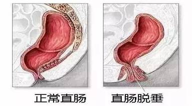 廣州東大肛腸醫(yī)院黑不黑此路不通。堵著堵著就越來越腸子卡了一大團(tuán)