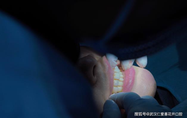 武漢仁愛口腔醫(yī)師告訴你:牙齒矯正復(fù)診少不了