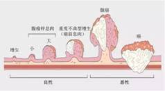 廣東民安醫(yī)院怎么樣:這么年輕,也沒家族史,30歲的他為什么會查出直腸癌?