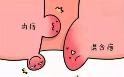 西安東大肛腸醫(yī)院好不好?肛腸界的“混世魔王”——混合痔