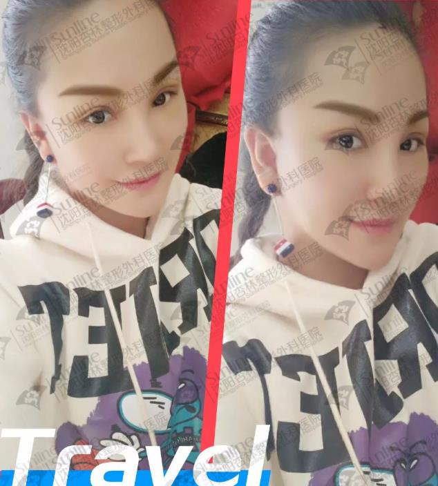 沈陽杏林整形醫(yī)院除皺手術(shù)價格多少