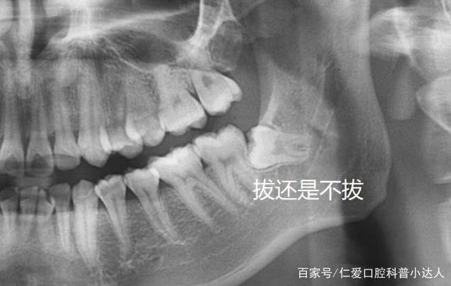 矯正拔正畸牙可以和智齒一起拔嗎?正畸牙一般拔牙多少錢?仁愛口腔醫(yī)師告訴你不可以,而且費(fèi)用是根據(jù)情況而定