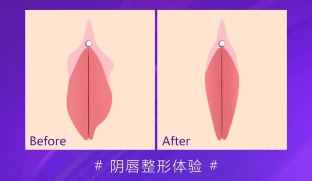 貴陽麗都私密整形醫(yī)院 小陰唇整形,解決你的私密困擾