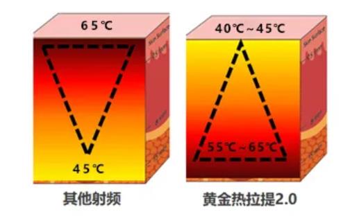 北京依一醫(yī)療美容焦?jié)升堻S金熱拉提2.0抗衰好嗎 黃金熱拉提2.0三大優(yōu)勢