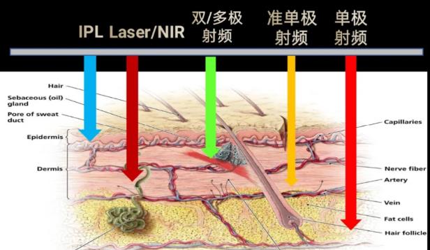 北京依一醫(yī)療美容焦?jié)升堻S金熱拉提2.0抗衰好嗎 黃金熱拉提2.0三大優(yōu)勢