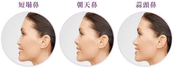 劉哲延隆鼻技術 昆明銅雀臺整形醫(yī)院為你打造魅力女神