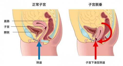 大連美琳達(dá)婦科醫(yī)院:關(guān)于漏尿,眾多女性的難言之隱怎么改
