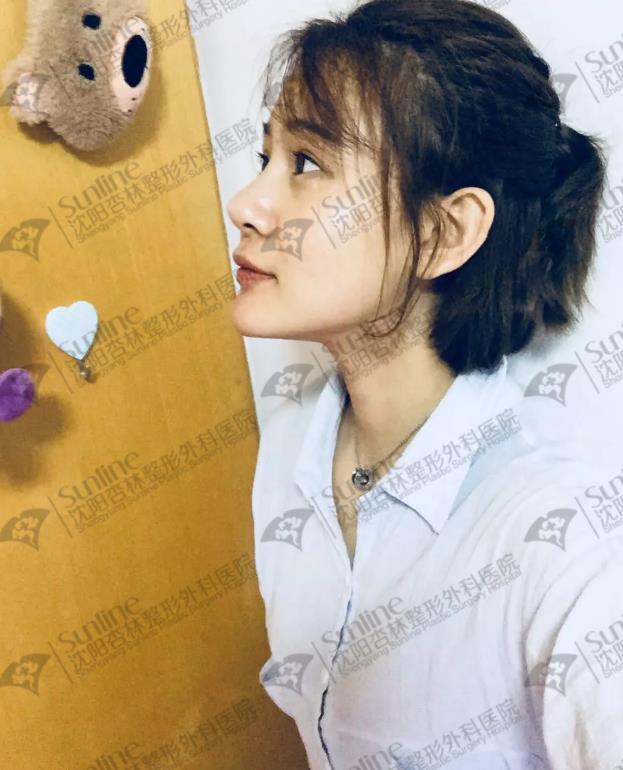 沈陽鼻綜合案例,杏林整形醫(yī)院案例
