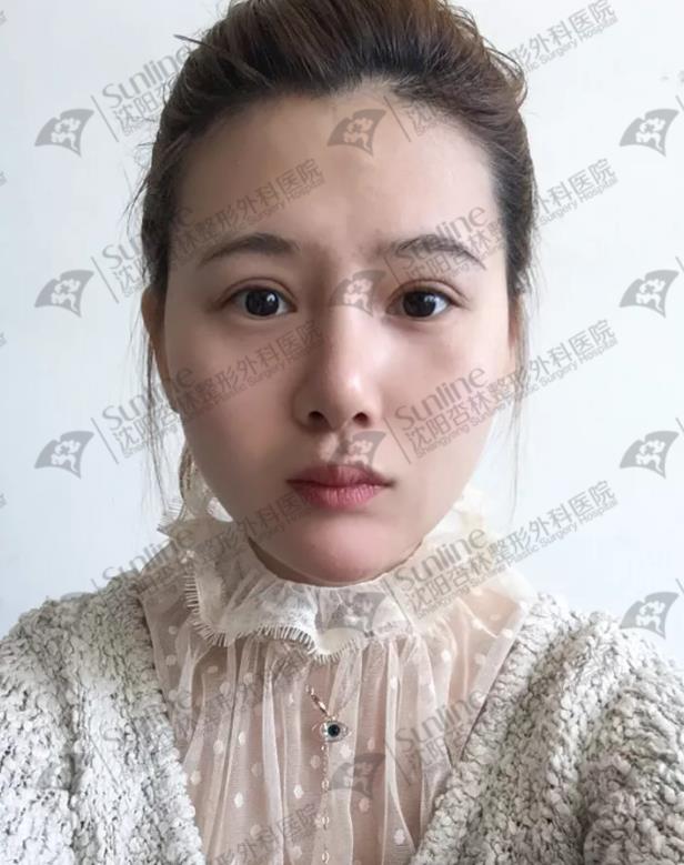 沈陽鼻綜合案例,杏林整形醫(yī)院案例