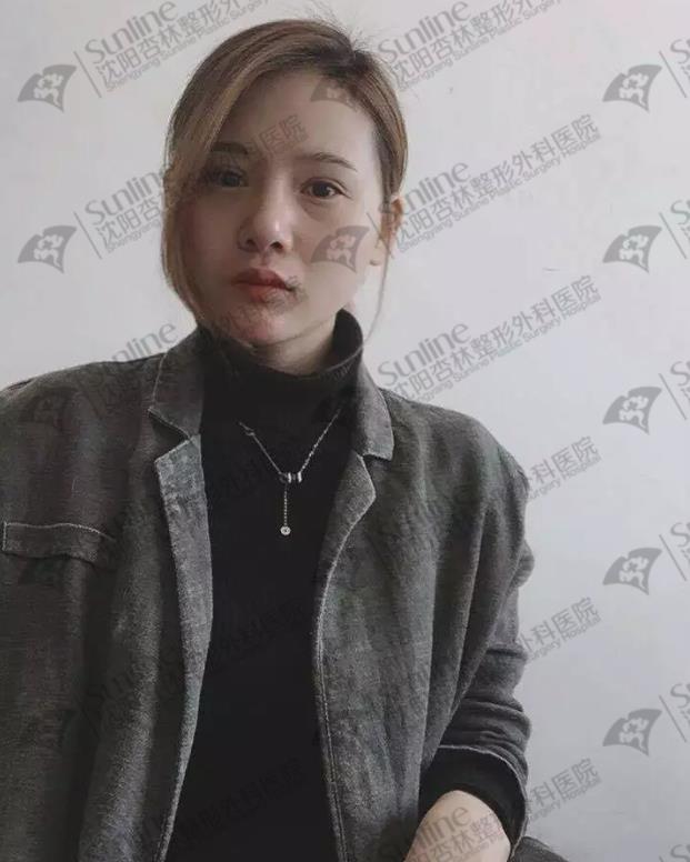 沈陽鼻綜合案例,杏林整形醫(yī)院案例