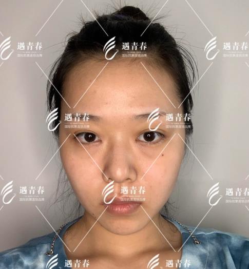 遇青春不開刀去眼袋,對癥“下藥”告別眼袋困擾!