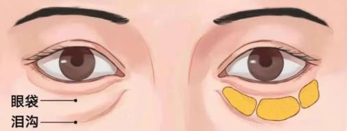 遇青春不開刀去眼袋,對癥“下藥”告別眼袋困擾!