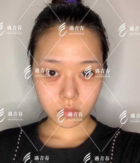 遇青春不開刀去眼袋,對癥“下藥”告別眼袋困擾!