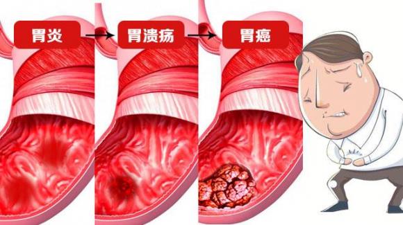 呼市東大肛腸醫(yī)院 早期胃癌不可怕,可怕的是被忽視!