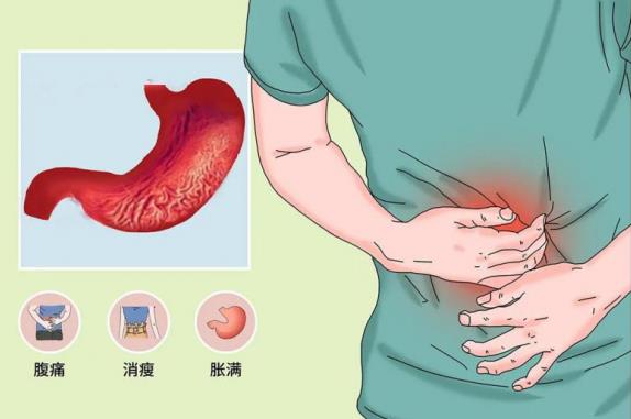 呼市東大肛腸醫(yī)院 早期胃癌不可怕,可怕的是被忽視!