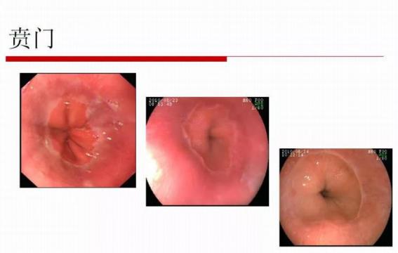 呼市東大肛腸醫(yī)院 早期胃癌不可怕,可怕的是被忽視!