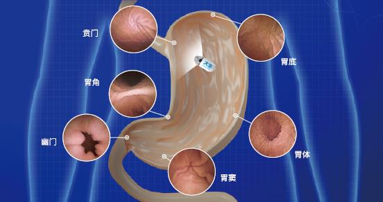 呼市東大肛腸醫(yī)院 早期胃癌不可怕,可怕的是被忽視!