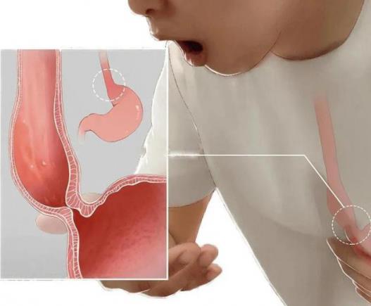 呼市東大肛腸醫(yī)院 早期胃癌不可怕,可怕的是被忽視!